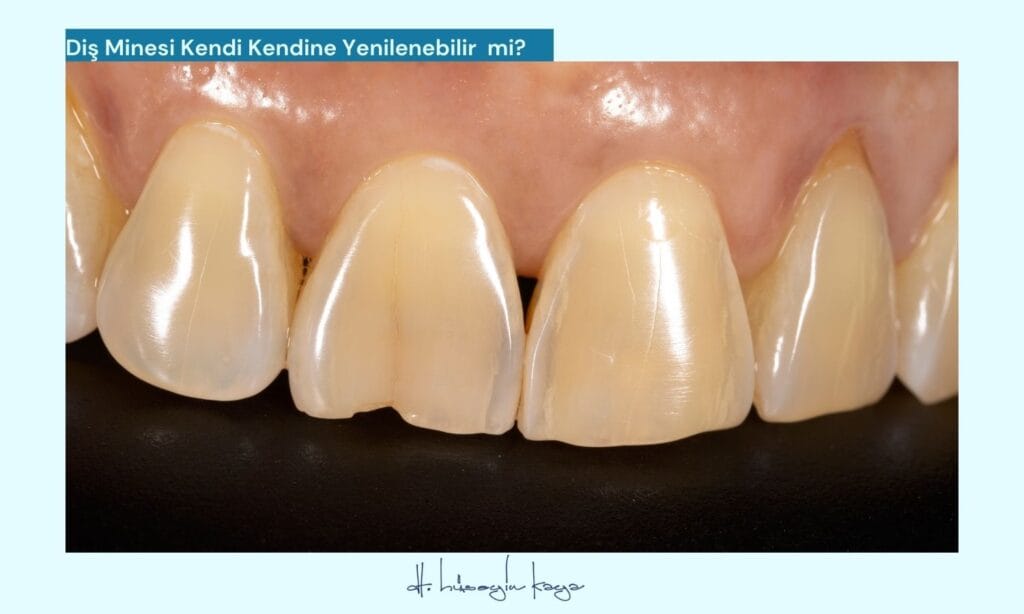 Diş Minesi Kendi Kendine Yenilenebilir mi?
