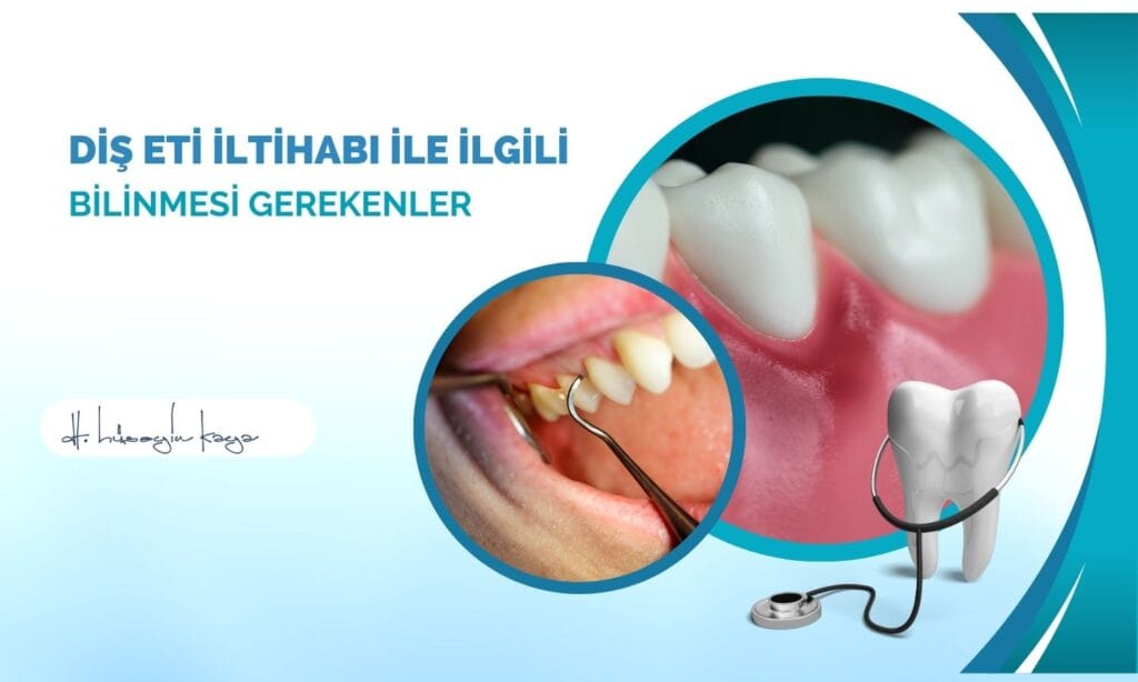 Diş Eti İltihabı İle İlgili Bilinmesi Gerekenler