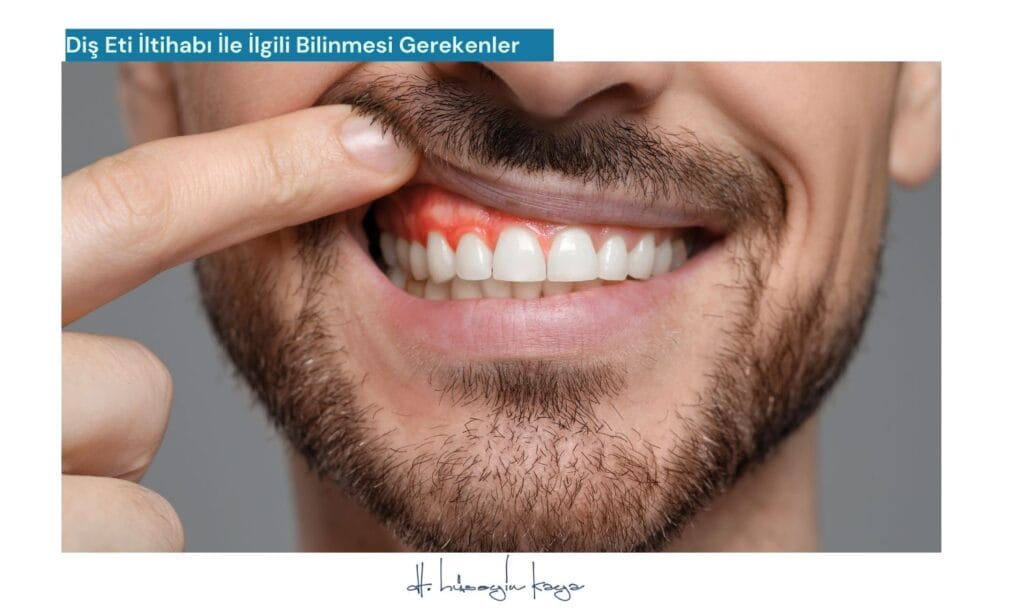 Diş Eti İltihabı İle İlgili Bilinmesi Gerekenler
