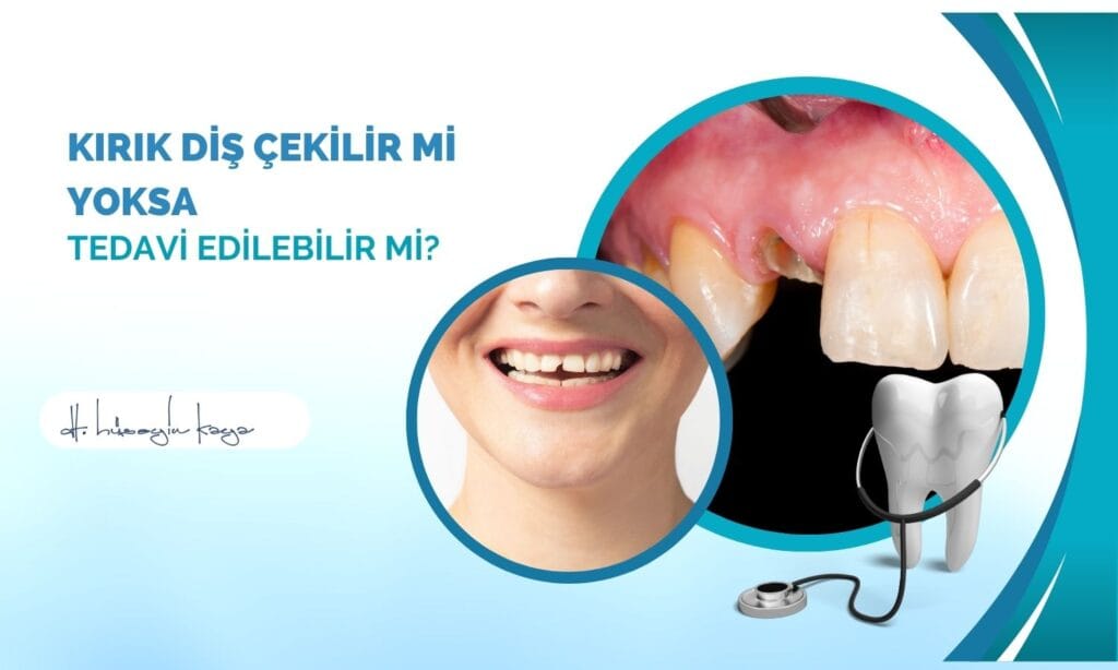 Kırık Diş Çekilir mi Yoksa Tedavi Edilebilir mi?
