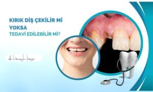 Kırık Diş Çekilir mi Yoksa Tedavi Edilebilir mi?