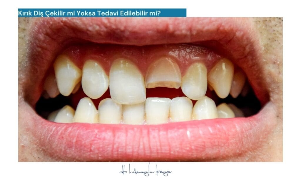 Kırık Diş Çekilir mi Yoksa Tedavi Edilebilir mi?