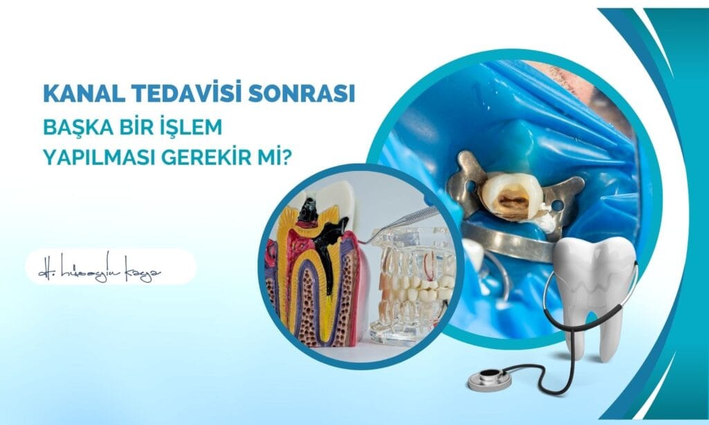 Kanal Tedavisi Sonrası Başka Bir İşlem Yapılması Gerekir mi?
