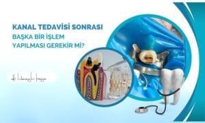 Kanal Tedavisi Sonrası Başka Bir İşlem Yapılması Gerekir mi?