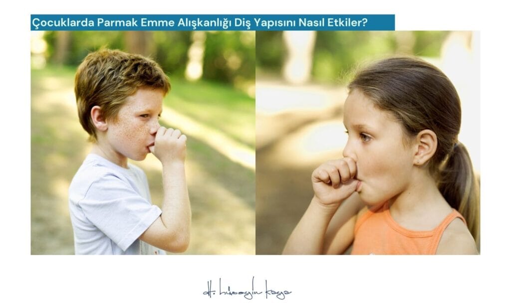 Çocuklarda Parmak Emme Alışkanlığı Diş Yapısını Nasıl Etkiler?