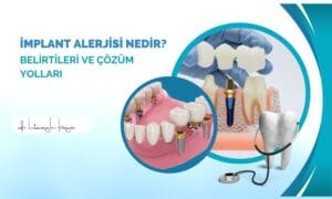 İMPLANT ALERJİSİ NEDİR? BELİRTİLERİ VE ÇÖZÜM YOLLARI