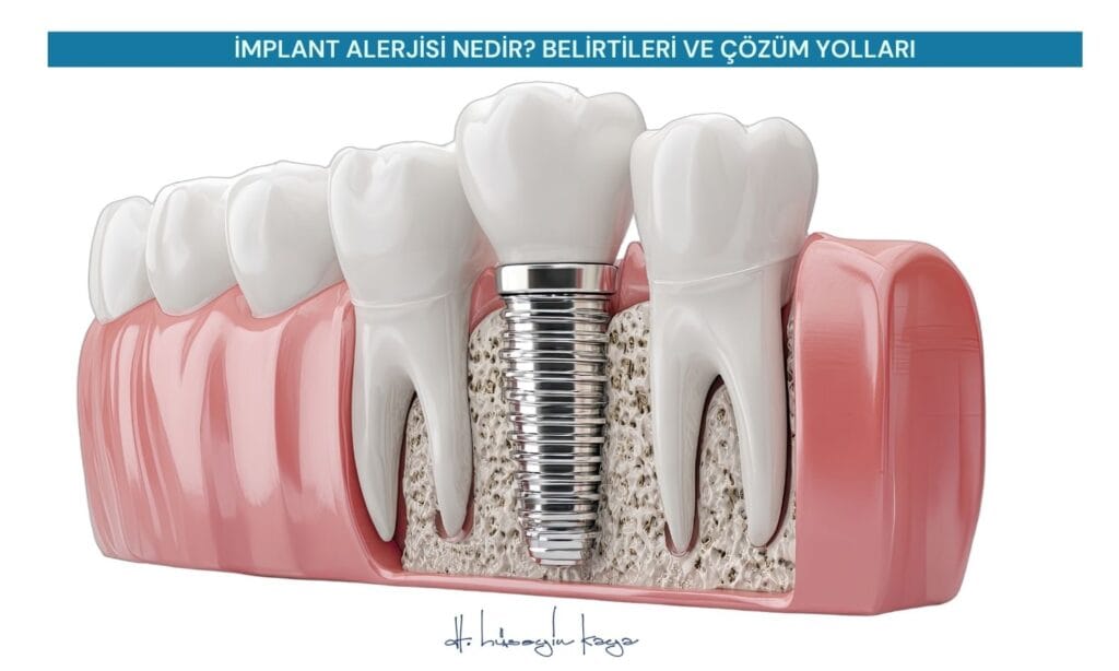 İMPLANT ALERJİSİ NEDİR? BELİRTİLERİ VE ÇÖZÜM YOLLARI