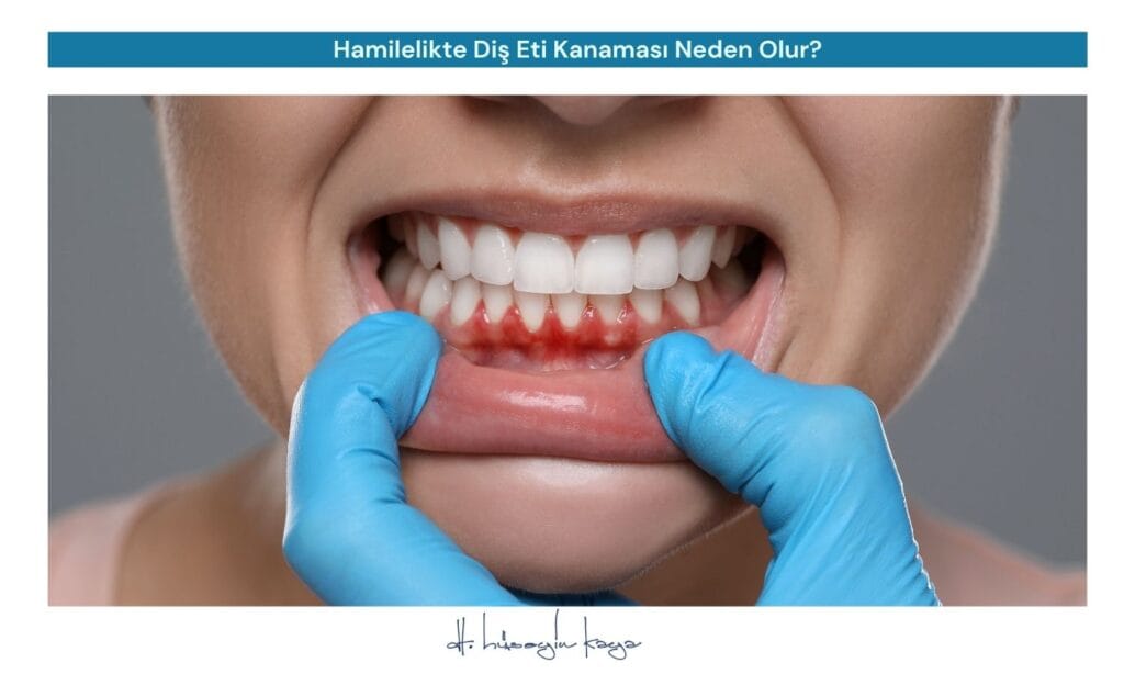 Hamilelikte Diş Eti Kanaması Neden Olur?