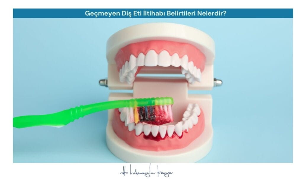Geçmeyen Diş Eti İltihabı Belirtileri Nelerdir?