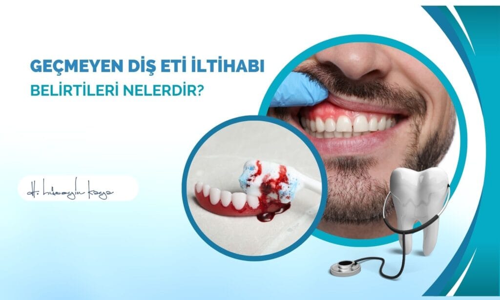 Geçmeyen Diş Eti İltihabı Belirtileri Nelerdir?