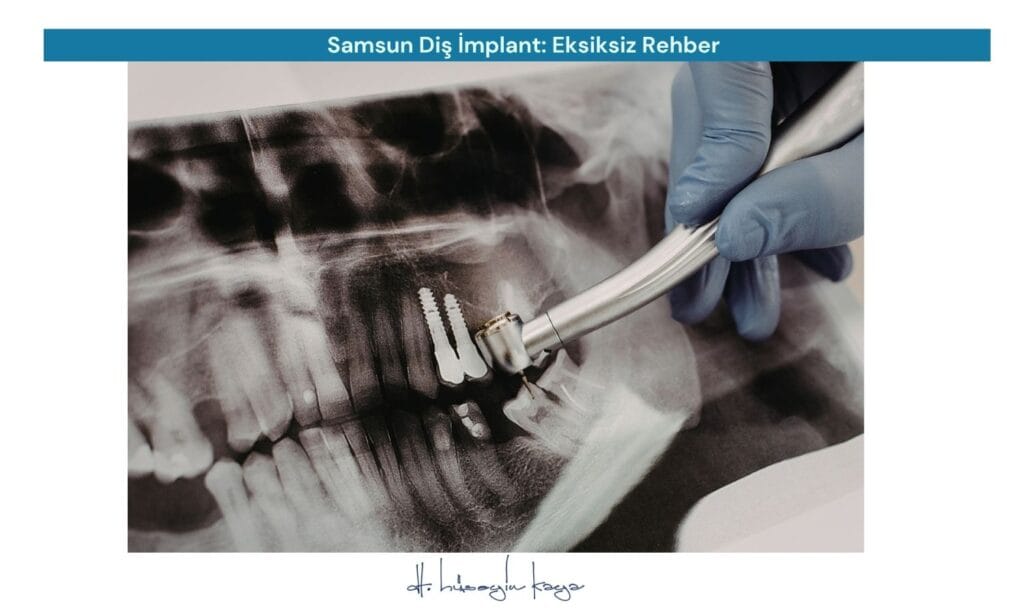 Samsun Diş İmplant: Eksiksiz Rehber