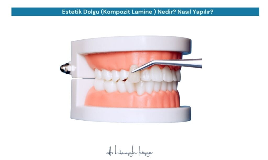 Estetik Dolgu (Kompozit Lamine ) Nedir? Nasıl Yapılır?