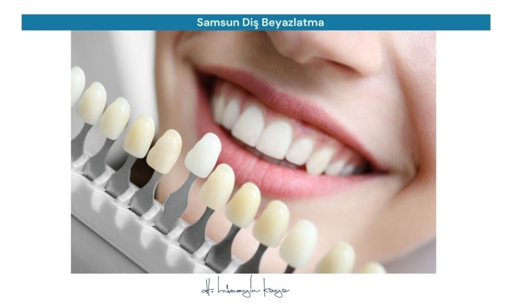 Samsun Diş Beyazlatma