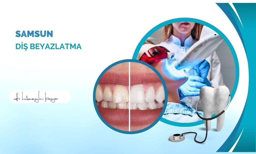 Samsun Diş Beyazlatma