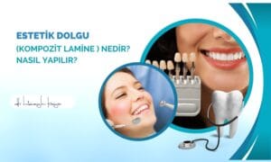 Estetik Dolgu (Kompozit Lamine ) Nedir? Nasıl Yapılır?