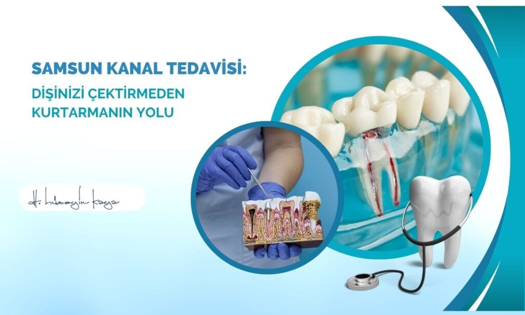 Samsun Kanal Tedavisi: Dişinizi Çektirmeden Kurtarmanın Yolu