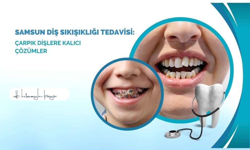 Samsun Diş Sıkışıklığı Tedavisi: Çarpık Dişlere Kalıcı Çözümler