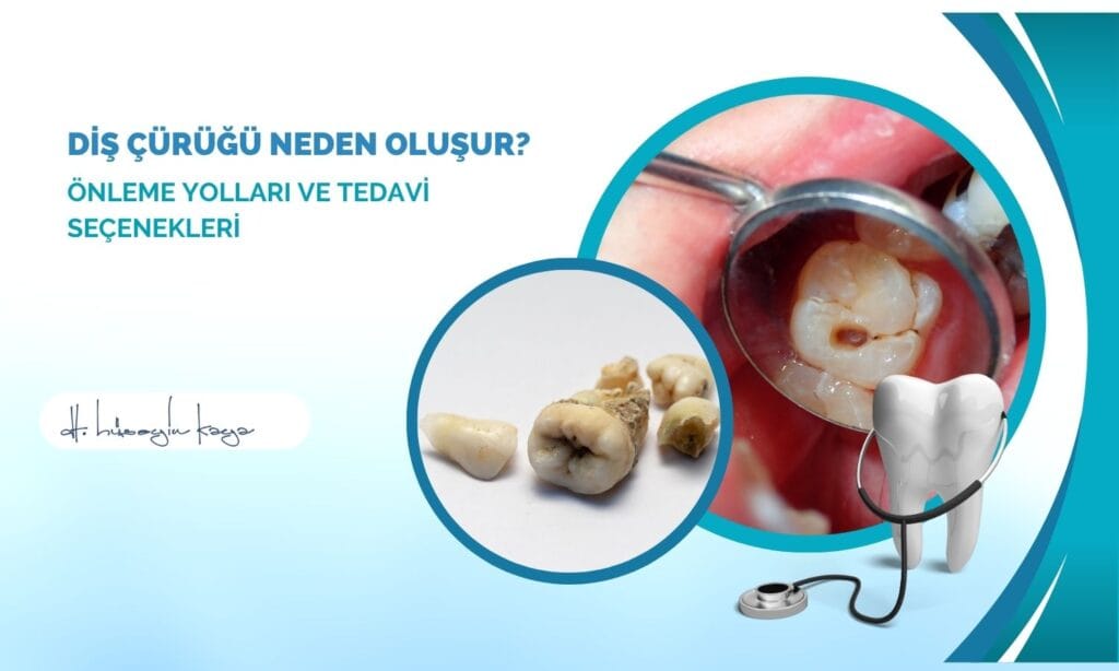 Diş Çürüğü Neden Oluşur? Önleme Yolları ve Tedavi Seçenekleri