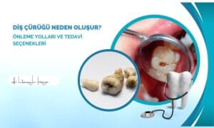 Diş Çürüğü Neden Oluşur? Önleme Yolları ve Tedavi Seçenekleri