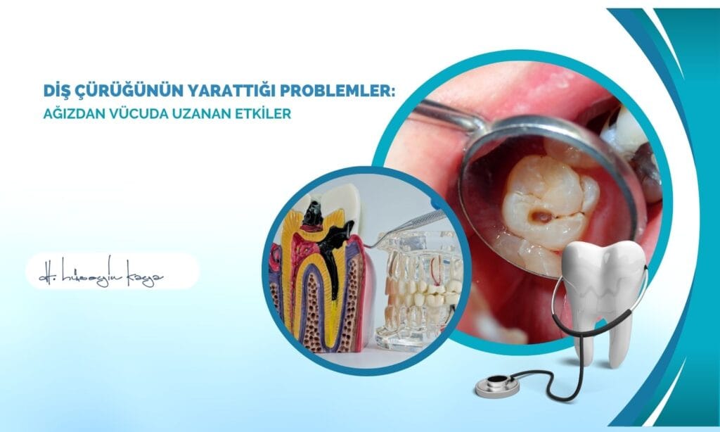 Diş Çürüğünün Yarattığı Problemler: Ağızdan Vücuda Uzanan Etkiler