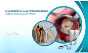 Diş Çürüğünün Yarattığı Problemler: Ağızdan Vücuda Uzanan Etkiler
