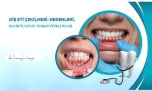 Diş Eti Çekilmesi: Nedenleri, Belirtileri ve Tedavi Yöntemleri